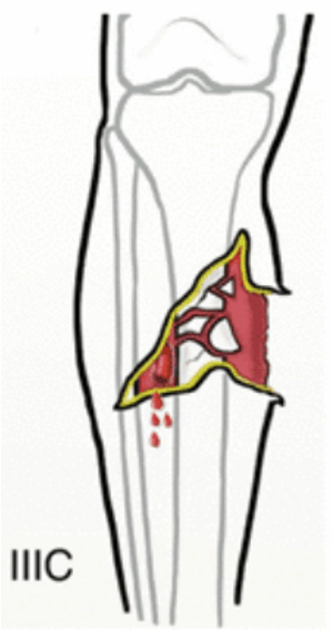 Grade IIIC open fracture clinical illustration